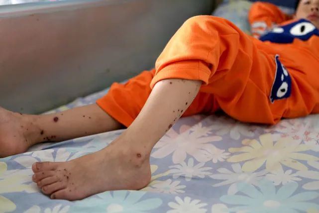 过李佳颖身高敏性紫癜患者的&ldquo;食物宝典&rdquo;,患者能吃什么?图1