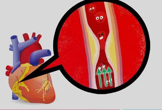 心血管堵塞 心血管堵塞