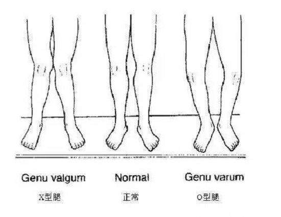 膝关节畸形 膝关节畸形