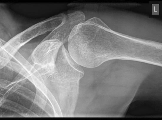 肩关节有哪些稳定结构？图1