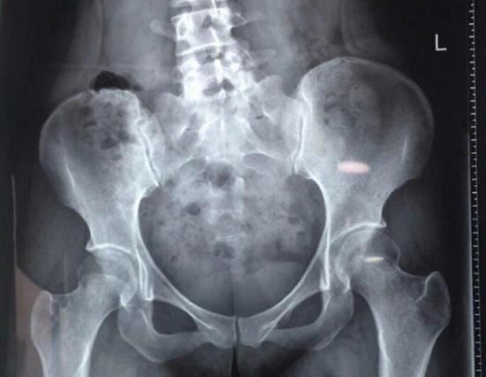 腰椎侧凸、骨盆高度不一