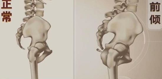 骨盆前倾、腰椎曲度变大的改善思路图1