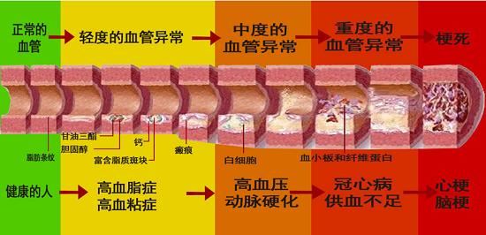 血管硬化是血管变硬了吗？红酒、鱼油和醋能够软化血管？图1