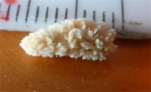 每天多喝水真的能预防结石吗？(每天多喝水真的能预防结石