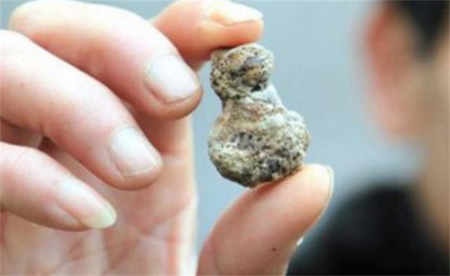 每天多喝水真的能预防结石吗？