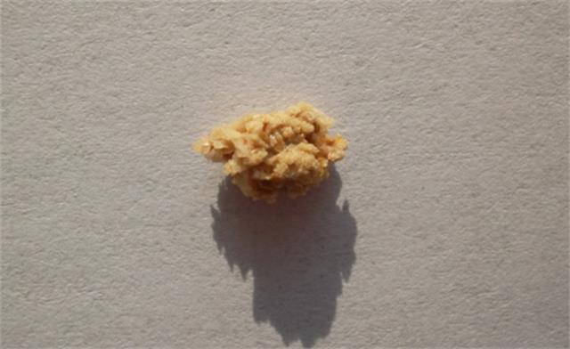 每天多喝水真的能预防结石吗？